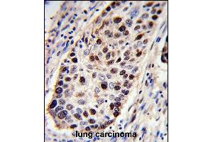 PCNA Antibody (C-term) (ABIN389344 and ABIN2839453) immunohistochemistry analysis in formalin fixed and paraffin embedded human lung carcinoma followed by peroxidase conjugation of the secondary antibody and DAB staining. (PCNA Antikörper  (C-Term))