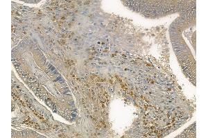 ABIN6260996 and ABIN6272569 at 1/100 staining human colon carcinoma by IHC-P. (COX7B Antikörper  (Internal Region))