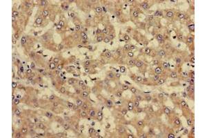 Immunohistochemistry of paraffin-embedded human liver cancer using ABIN7144337 at dilution of 1:100 (SERPINC1 Antikörper  (AA 37-180))