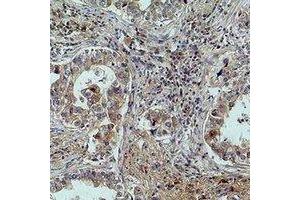 Immunohistochemical analysis of MICU1 staining in human lung cancer formalin fixed paraffin embedded tissue section. (MICU1 Antikörper)