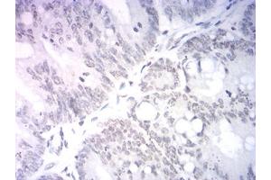 Immunohistochemical analysis of paraffin-embedded rectum cancer tissues using Neurod mouse mAb with DAB staining. (NEUROD1 Antikörper  (AA 26-91))