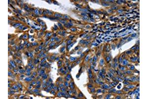 The image on the left is immunohistochemistry of paraffin-embedded Human ovarian cancer tissue using ABIN7189591(ABCC5 Antibody) at dilution 1/50, on the right is treated with synthetic peptide. (ABCC5 Antikörper)