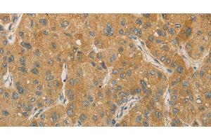 Immunohistochemistry of paraffin-embedded Human liver cancer tissue using PRPSAP1 Polyclonal Antibody at dilution 1:80 (PRPSAP1 Antikörper)