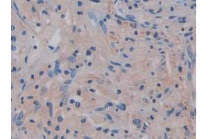 IHC-P analysis of Human Lung cancer Tissue, with DAB staining. (IL17RA Antikörper  (AA 377-534))