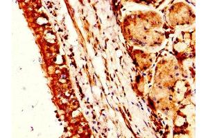 IHC image of ABIN7161457 diluted at 1:300 and staining in paraffin-embedded human lung cancer performed on a Leica BondTM system. (Neurotensin Antikörper  (AA 24-143))