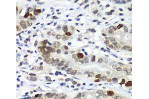 Immunohistochemistry of paraffin-embedded Human gastric cancer using DR1 Polyclonal Antibody at dilution of 1:100 (40x lens). (DR1 Antikörper)