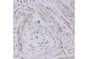 Anti-GLUT4 Picoband antibody,  IHC(P): Human Intestinal Cancer Tissue (GLUT4 Antikörper  (AA 333-509))