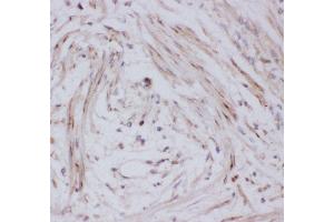 Anti-GLUT4 Picoband antibody,  IHC(P): Human Intestinal Cancer Tissue