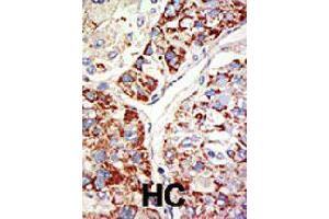 Formalin-fixed and paraffin-embedded human hepatocellular carcinoma tissue reacted with EZH1 polyclonal antibody  , which was peroxidase-conjugated to the secondary antibody, followed by DAB staining . (EZH1 Antikörper  (Internal Region))