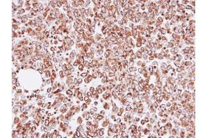 IHC-P Image Immunohistochemical analysis of paraffin-embedded human gastric cancer, using OAT, antibody at 1:100 dilution. (OAT Antikörper)