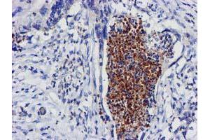 Immunohistochemical staining of paraffin-embedded Carcinoma of Human pancreas tissue using anti-EXOSC7 mouse monoclonal antibody. (EXOSC7 Antikörper)