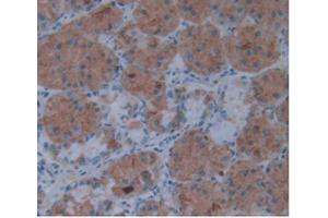 IHC-P analysis of Human Stomach Cancer Tissue, with DAB staining. (IL1A Antikörper  (AA 113-271))