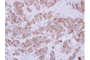 IHC-P Image Immunohistochemical analysis of paraffin-embedded human breast cancer, using TIP30, antibody at 1:250 dilution.