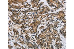 Immunohistochemistry of Human colon cancer using SYN1 Polyclonal Antibody at dilution of 1:50 (SYN1 Antikörper)