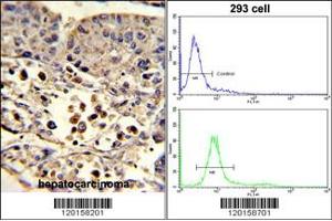 (LEFT)Formalin-fixed and paraffin-embedded human hepatocarcinoma reacted with ETHE1 Antibody (C-term), which was peroxidase-conjugated to the secondary antibody, followed by DAB staining. (ETHE1 Antikörper  (C-Term))