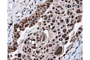 Immunohistochemical staining of paraffin-embedded Adenocarcinoma of breast tissue using anti-KIAA1609 mouse monoclonal antibody. (KIAA1609 Antikörper)
