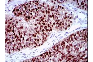 Immunohistochemical analysis of paraffin-embedded ovarian cancer tissues using PLAGL1 mouse mAb with DAB staining.