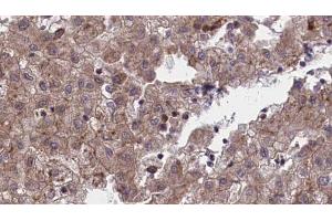 ABIN6273972 at 1/100 staining Human liver cancer tissue by IHC-P. (OR1L1 Antikörper)
