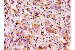 Immunohistochemistry of paraffin-embedded human liver cancer using ABIN7160310 at dilution of 1:100 (ABCB1 Antikörper  (AA 236-297))