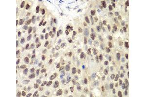 Immunohistochemistry of paraffin-embedded Human lung cancer using MCM6 Polyclonal Antibody at dilution of 1:100 (40x lens).