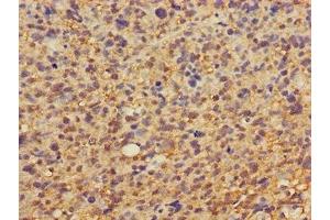 Immunohistochemistry of paraffin-embedded human glioma using ABIN7149878 at dilution of 1:100 (DKK1 Antikörper  (AA 33-266))