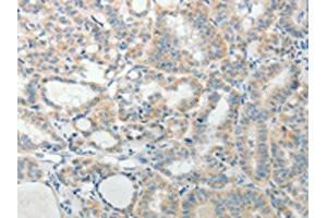 The image on the left is immunohistochemistry of paraffin-embedded Human thyroid cancer tissue using ABIN7189711(AGAP1 Antibody) at dilution 1/25, on the right is treated with synthetic peptide. (AGAP1 Antikörper)