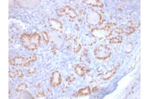 Formalin-fixed, paraffin-embedded human Lung Adenocarcinoma stained with TTF-1 Mouse Recombinant Monoclonal Antibody (rNX2. (Rekombinanter NKX2-1 Antikörper)