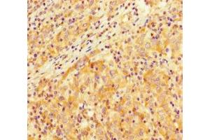 Immunohistochemistry of paraffin-embedded human lung cancer using ABIN7172403 at dilution of 1:100 (SMARCA4 Antikörper  (AA 808-1092))