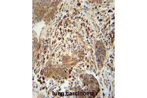 TAGAP antibody (Center) immunohistochemistry analysis in formalin fixed and paraffin embedded human lung carcinoma followed by peroxidase conjugation of the secondary antibody and DAB staining. (TAGAP Antikörper  (Middle Region))