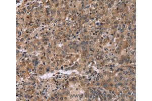 Immunohistochemistry of Human colon cancer using FAM107A Polyclonal Antibody at dilution of 1:30 (FAM107A Antikörper)