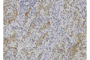 ABIN6279086 at 1/100 staining Human lung cancer tissue by IHC-P. (ADAMTS14 Antikörper  (C-Term))