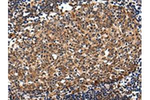 The image on the left is immunohistochemistry of paraffin-embedded Human colorectal cancer tissue using ABIN7193115(ZNF473 Antibody) at dilution 1/30, on the right is treated with synthetic peptide.