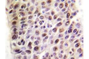 Immunohistochemistry analyzes of TIP60 antibody in paraffin-embedded human liver carcinoma tissue. (KAT5 Antikörper)