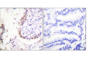 Immunohistochemical analysis of paraffin-embedded human lung carcinoma tissue, using OCT3 antibody (ABIN5976473). (OCT4 Antikörper  (Internal Region))
