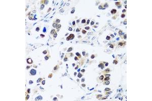 Immunohistochemistry of paraffin-embedded human lung cancer using BRIX1 antibody (ABIN7265951) at dilution of 1:100 (40x lens). (BRIX1 Antikörper  (AA 1-353))