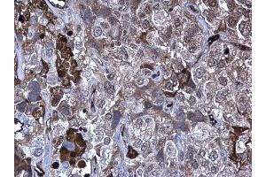 IHC-P Image MMP10 antibody detects MMP10 protein at secreted on human cervical carcinoma by immunohistochemical analysis. (MMP10 Antikörper)