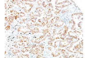 Formalin-fixed, paraffin-embedded human Lung SCC stained with Cytokeratin 7 Monoclonal Antibody (SPM270). (Cytokeratin 7 Antikörper)
