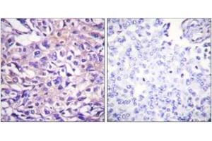 Immunohistochemistry analysis of paraffin-embedded human breast carcinoma, using MYPT1 (Phospho-Thr696) Antibody. (PPP1R12A Antikörper  (pThr696))