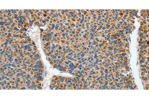 Immunohistochemistry of paraffin-embedded Human liver cancer using DSCR1 Polyclonal Antibody at dilution of 1:45 (RCAN1 Antikörper)