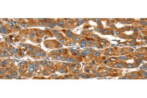 Immunohistochemistry of paraffin-embedded Human liver cancer using ERP44 Polyclonal Antibody at dilution of 1/20 (ERP44 Antikörper)