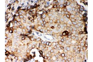 Anti- STIM1 Picoband antibody, IHC(P) IHC(P): Human Mammary Cancer Tissue (STIM1 Antikörper  (N-Term))