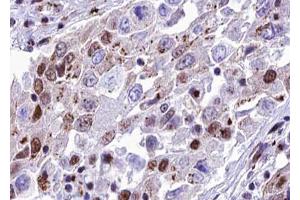 ABIN6267599 at 1/100 staining human lung carcinoma tissue sections by IHC-P.