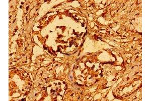 Immunohistochemistry of paraffin-embedded human breast cancer using  at dilution of 1:100 (GAB1 Antikörper  (AA 119-329))