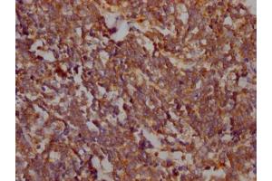 IHC image of ABIN7127482 diluted at 1:100 and staining in paraffin-embedded human lung cancer performed on a Leica BondTM system. (Rekombinanter FAK Antikörper)