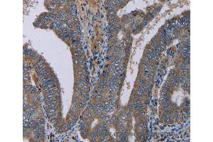 Immunohistochemistry of Human liver cancer using PVRL4 Polyclonal Antibody at dilution of 1:40 (PVRL4 Antikörper)
