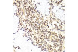 Immunohistochemistry of paraffin-embedded human adenomyosis using PHC1 antibody at dilution of 1:200 (400x lens). (PHC1 Antikörper)