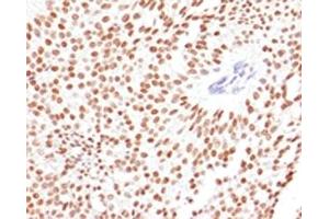 IHC testing of FFPE human bladder carcinoma with FOXA1 antibody. (FOXA1 Antikörper  (AA 372-472))