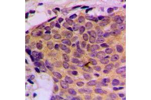 Immunohistochemical analysis of STAT5 staining in human breast cancer formalin fixed paraffin embedded tissue section. (STAT5A Antikörper  (C-Term))