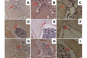 Representative images of immunohistochemical OPG expression in the mandible of Wistar rats in diabetic group with ×200 magnification (A), ×400 magnification (B), ×1,000 magnification (C); osteoporotic group with ×200 magnification (D), ×400 magnification (E), ×1,000 magnification (F); and control group with ×200 magnification (G), ×400 magnification (H), ×1,000 magnification (I); and OPG-positive cells were observed (red arrow). (Osteoprotegerin Antikörper  (N-Term))