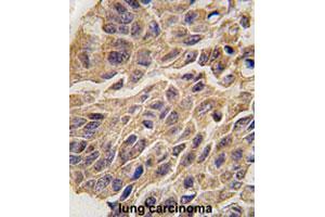 Formalin-fixed and paraffin-embedded human lung carcinomareacted with IDO1 polyclonal antibody , which was peroxidase-conjugated to the secondary antibody, followed by AEC staining. (IDO1 Antikörper  (C-Term))